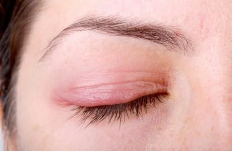 woman with chalazion, close-up