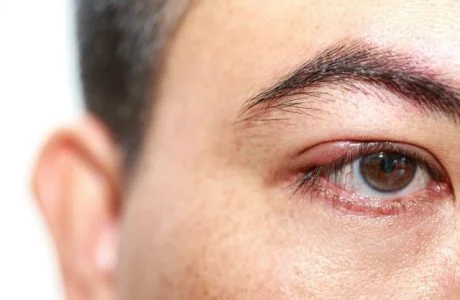 When should a chalazion be incised and curetted?