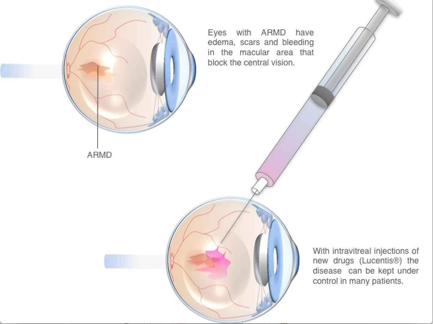 macular degeneration treatment