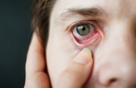 Help! I want to find out how to cure my conjunctivitis