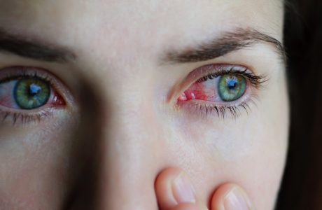 How to sort out your recurring conjunctivitis