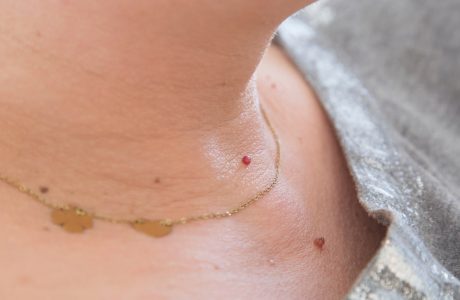 Bothered by skin tags? We can remove them