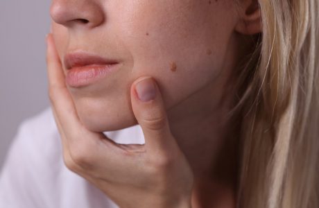 Troubled by skin tags? Have them removed quickly and painlessly
