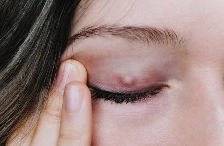 How do you know whether you need medical or surgical treatment for your chalazion (eyelid lump)?