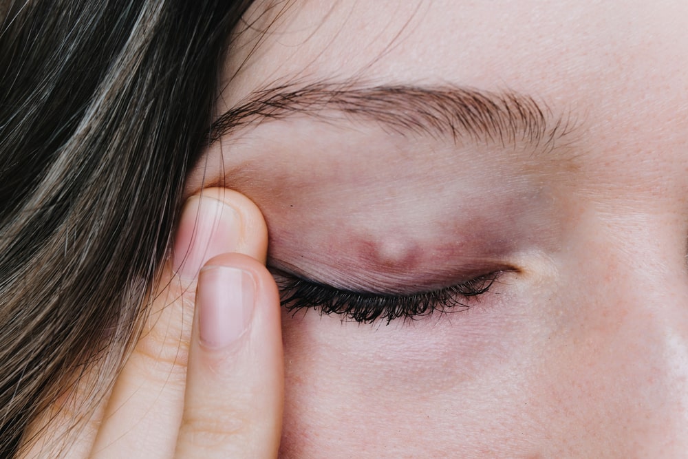 Treatment For Chalazion (Eyelid Lump) - Clinica London