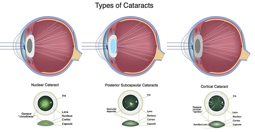 illustration of the types of cataracts