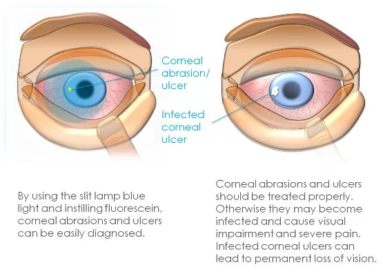 Corneal Abrasion and Ulcer 1