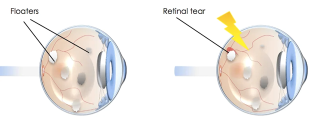 Floaters and retinal tear explanation