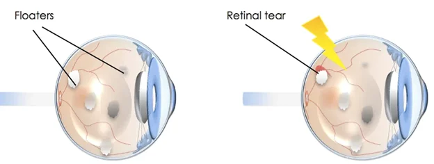 Floaters and retinal tear explanation